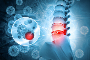 SCI Accident Risks: Breaking Down Causes and Factors of Spinal Cord Injuries