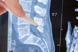 Did Your Henderson, NV, Car Accident Cause Spinal Stenosis?